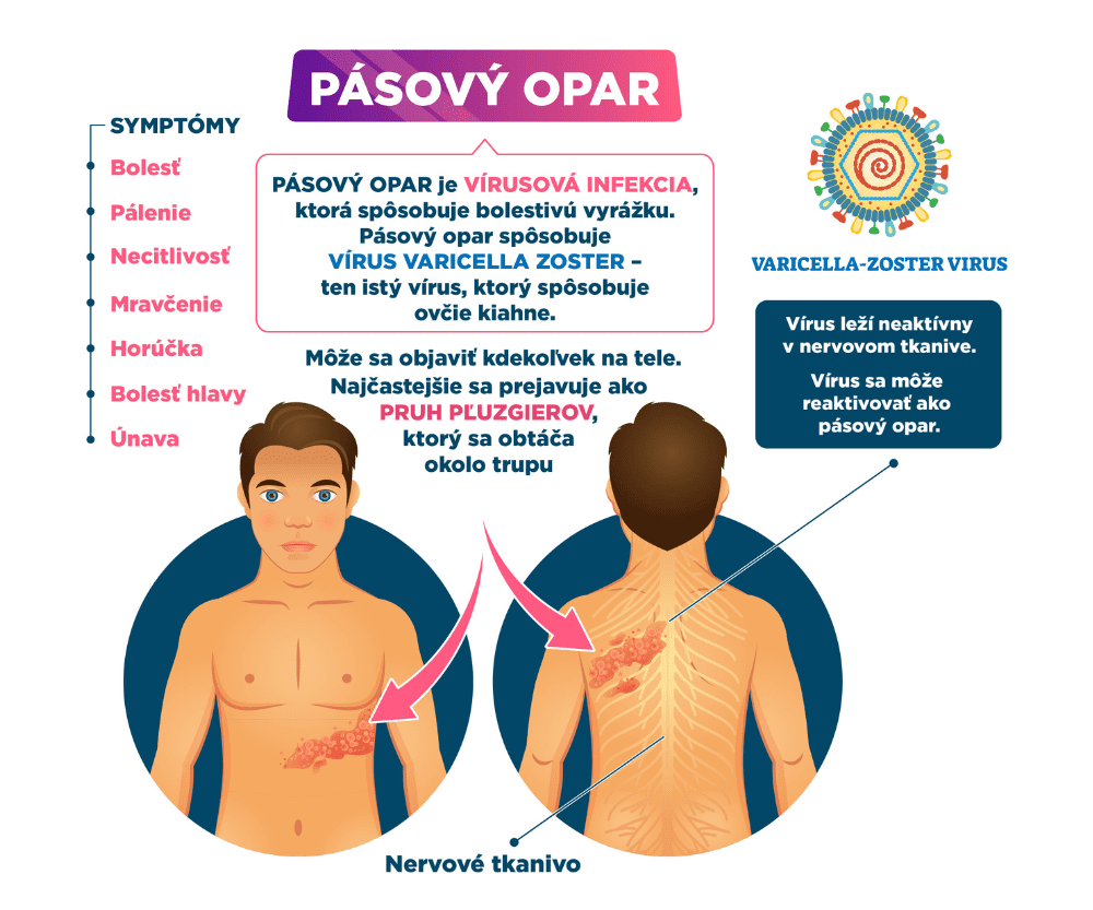 Infografika zobazuje pásový opar a jeho symptómy ako bolesť, pálenie, necitlivosť, únava, horúčka.