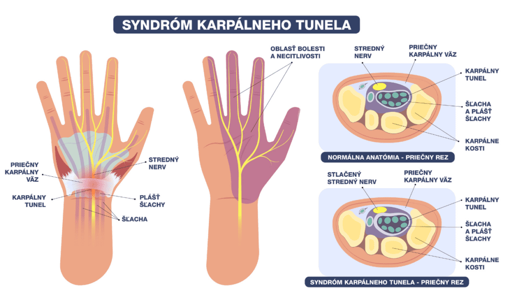 Infografika zobrazujúca normálnu anatómiu zdravej ruky a anatómiu ruky s karpálnym tunelom.