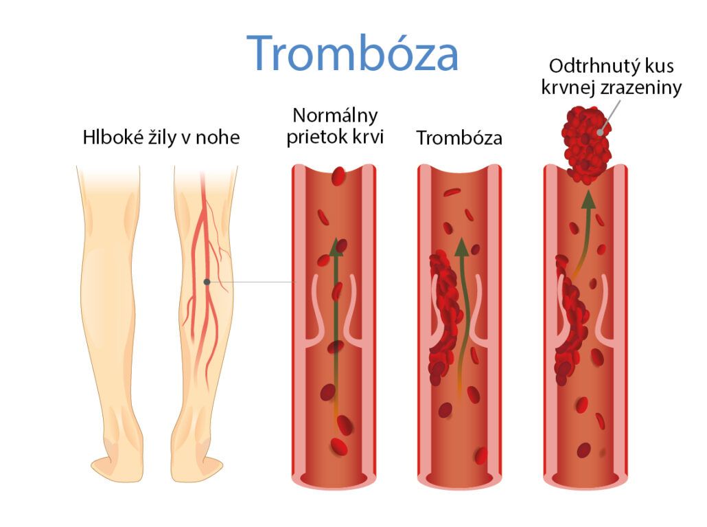 Infografika zobrazuje trombózu a krvnú zrazeninu, ktorá sa od nej odlúči a môže spôsobiť embóliu.